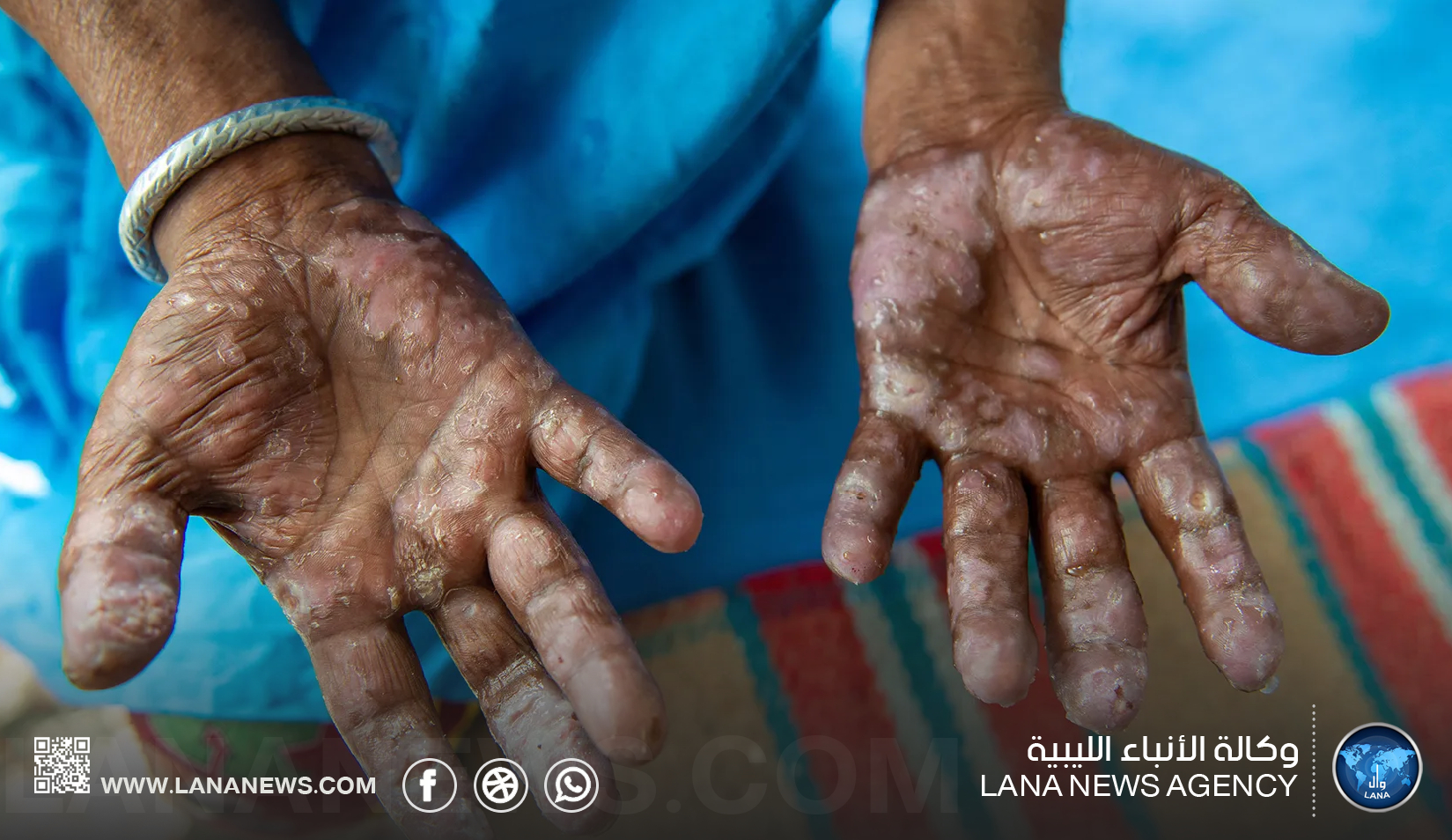 مركز بنغازي الطبي يحيي اليوم العالمي لمرض الجذام تحت إشراف قسم الجلدية